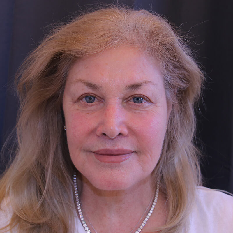 Facelift - Patient After