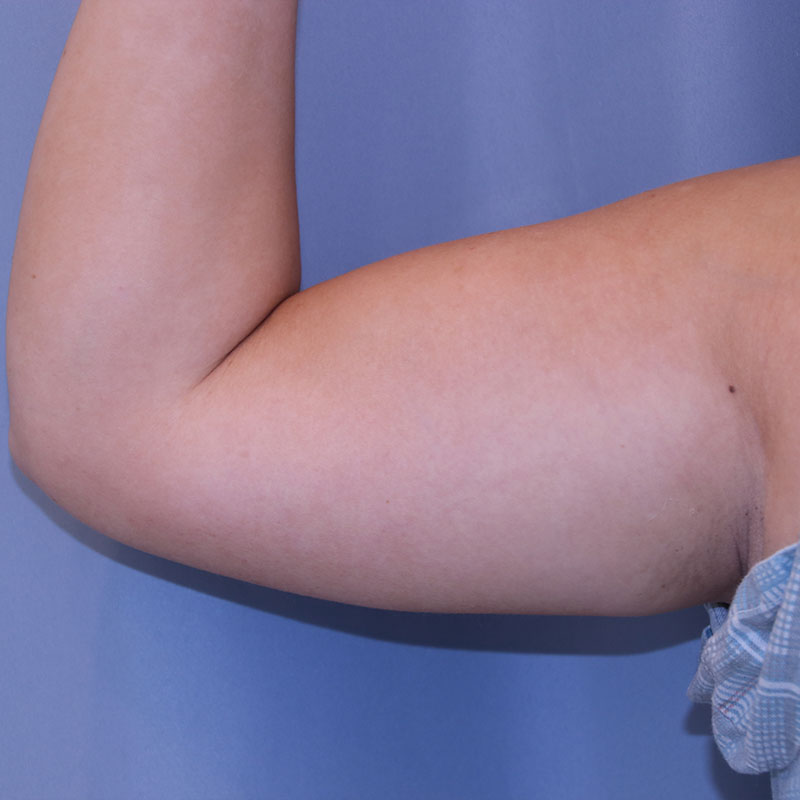 Liposuction - Patient Before