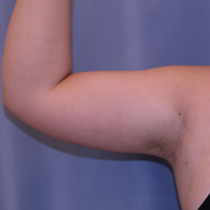 Liposuction - Patient After