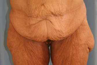 Massive-Weight-Loss-Body-Contouring-Case--03 | Before Massive Weight Loss Body Contouring