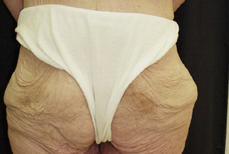 Massive-Weight-Loss-Body-Contouring-Case--02 | Before Massive Weight Loss Body Contouring