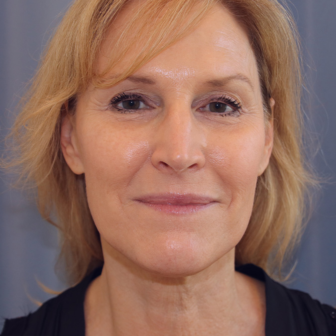 Neck-Lift-Case--03 | Before Neck Lift