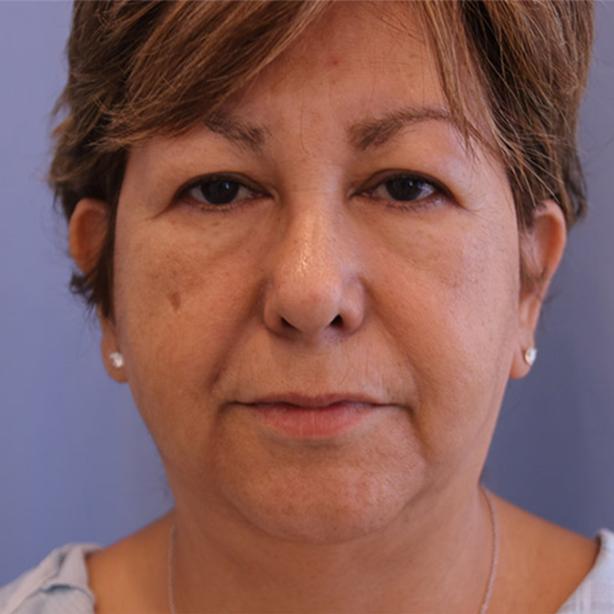 Otoplasty-Case--01 | Before Otoplasty