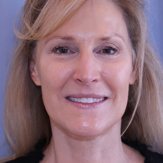 Neck-Lift-Case--03 | After Neck Lift