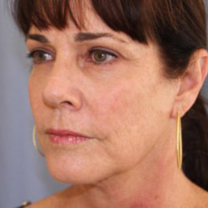 Neck Lift - Patient After