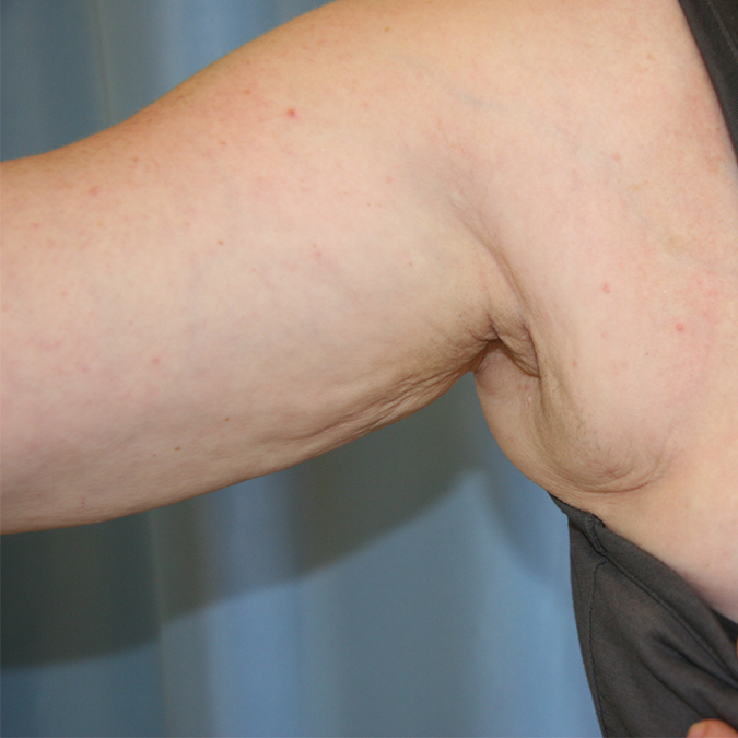 Arm-Lift-Case--06 | Before Arm Lift