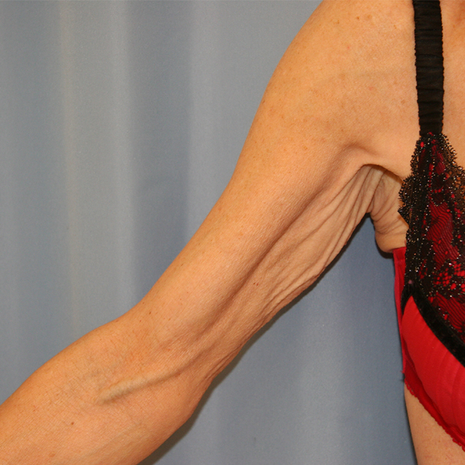 Arm-Lift-Case--07 | Before Arm Lift