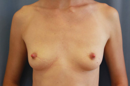 Breast-Augmentation-Case--18 | Before Breast Augmentation