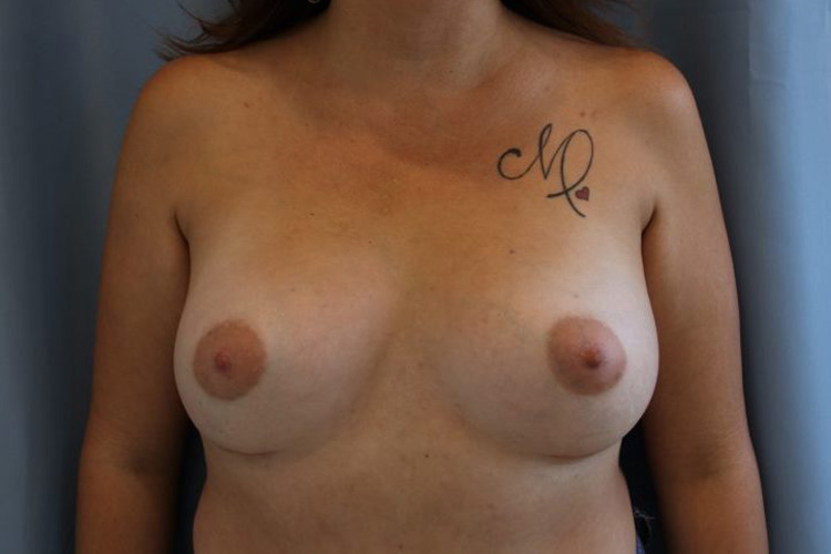 Breast-Augmentation-Case--10 | After Breast Augmentation