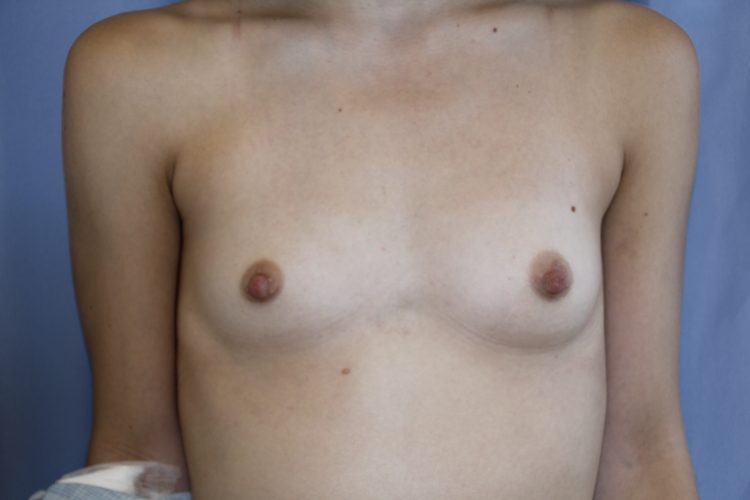 Breast-Augmentation-Case--13 | Before Breast Augmentation