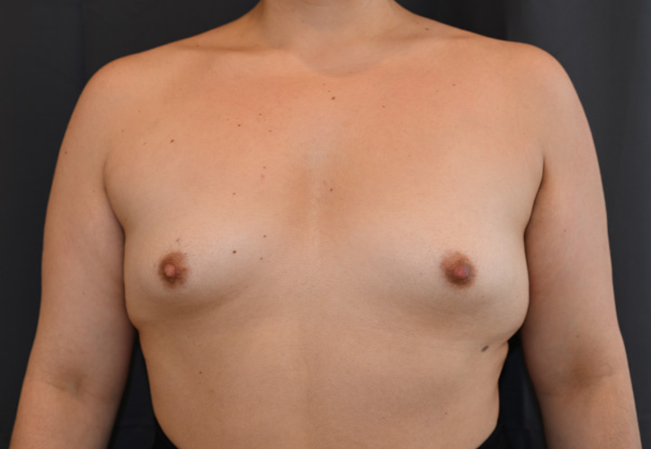 Breast-Augmentation-Case--58 | Before Breast Augmentation