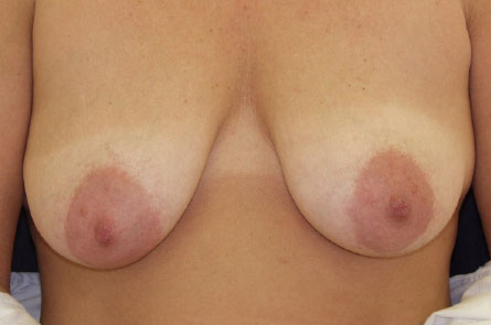 Breast-Lift-With-Augmentation-Case--11 | Before Breast Lift With Augmentation