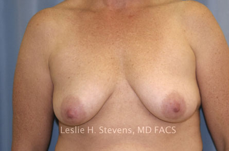 Case--3610 | Before Breast Lift With Augmentation