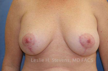 Case--3610 | After Breast Lift With Augmentation