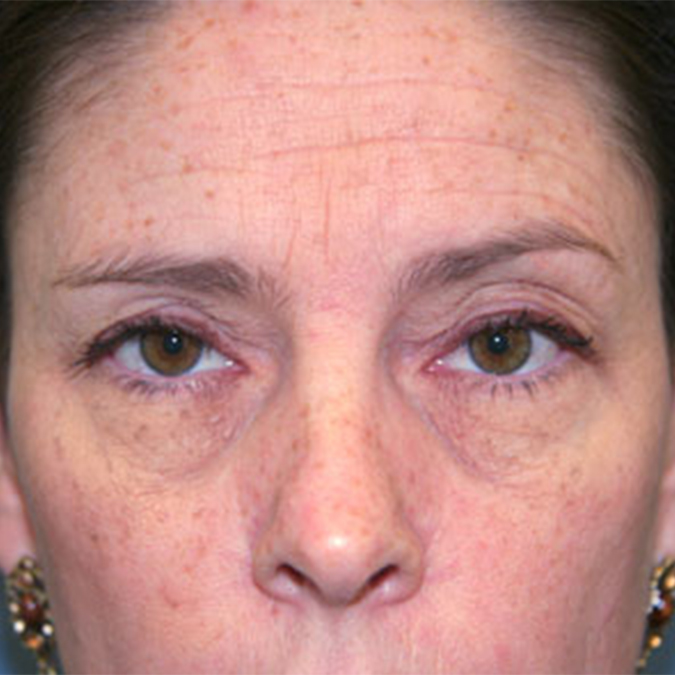 Brow-Lift-Case--03 | Before Brow Lift