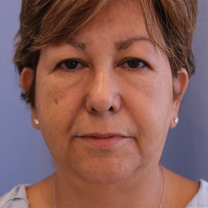 Eyelid-Surgery-Case--02 | Before Eyelid Surgery