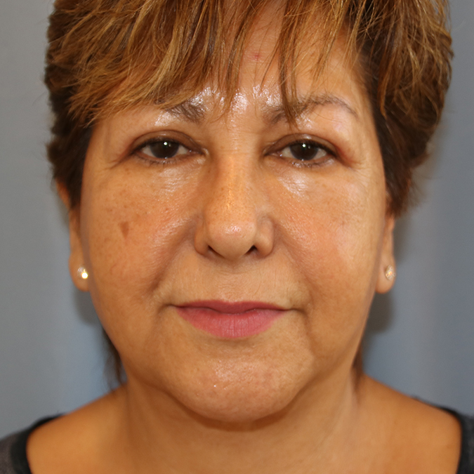 Eyelid-Surgery-Case--02 | After Eyelid Surgery