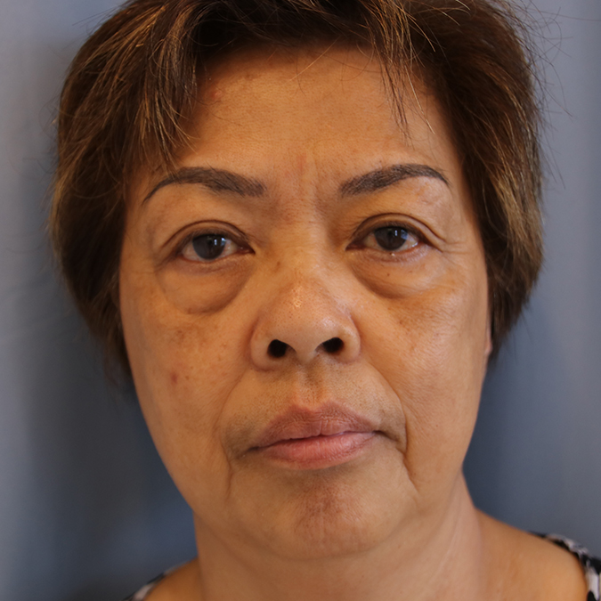 Eyelid-Surgery-Case--03 | Before Eyelid Surgery