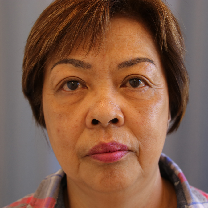 Eyelid-Surgery-Case--03 | After Eyelid Surgery