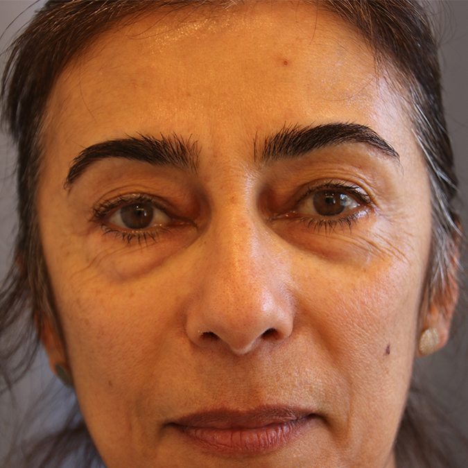 Eyelid-Surgery-Case--04 | Before Eyelid Surgery