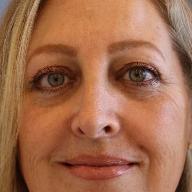 Eyelid-Surgery-Case--05 | After Eyelid Surgery