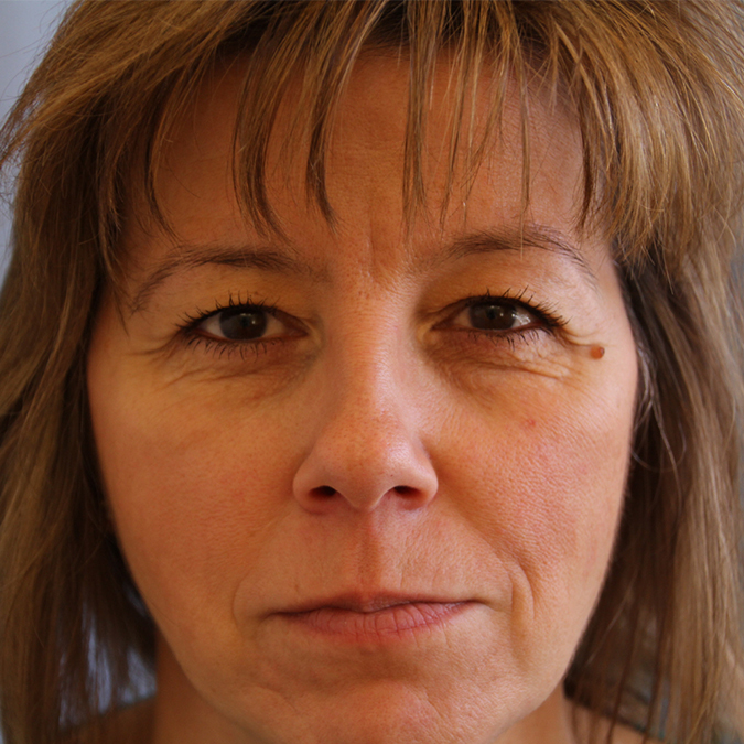 Eyelid-Surgery-Case--06 | Before Eyelid Surgery