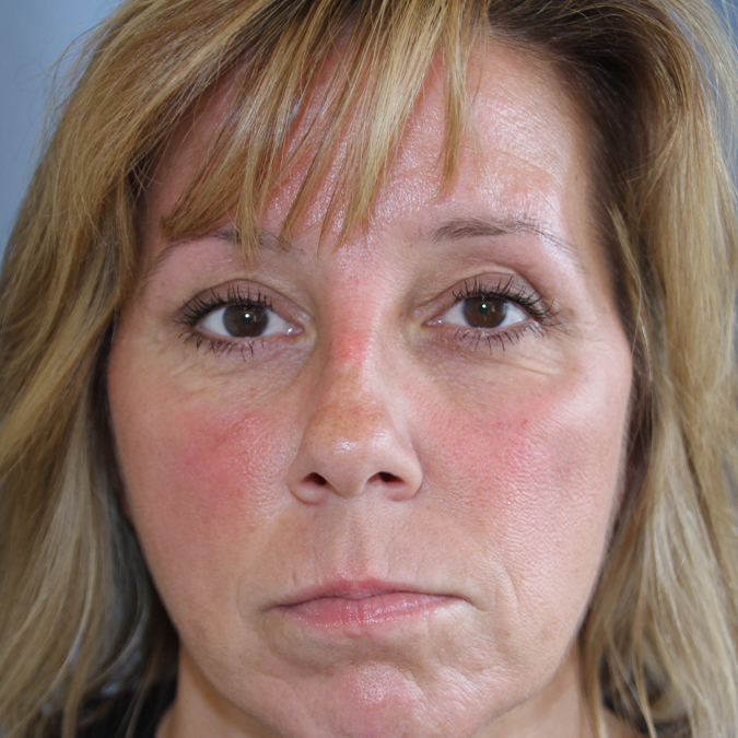 Eyelid-Surgery-Case--06 | After Eyelid Surgery