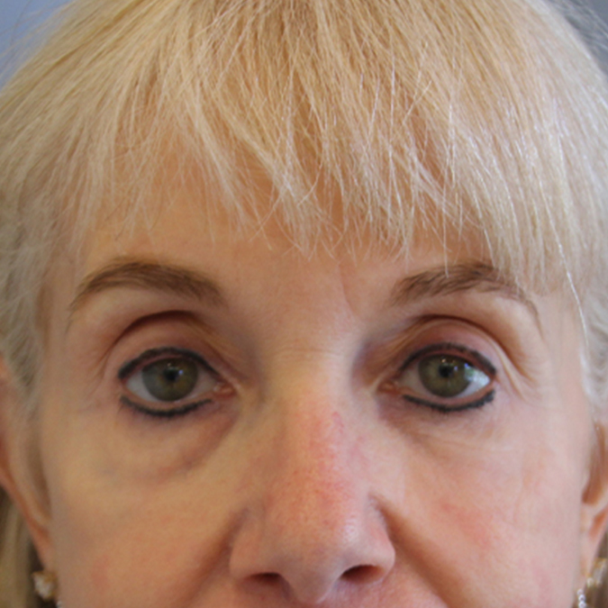 Eyelid-Surgery-Case--07 | Before Eyelid Surgery