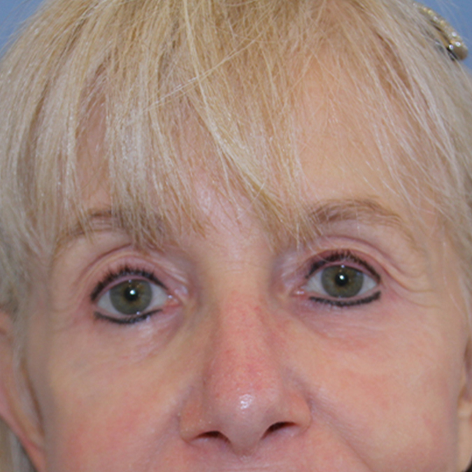 Eyelid-Surgery-Case--07 | After Eyelid Surgery