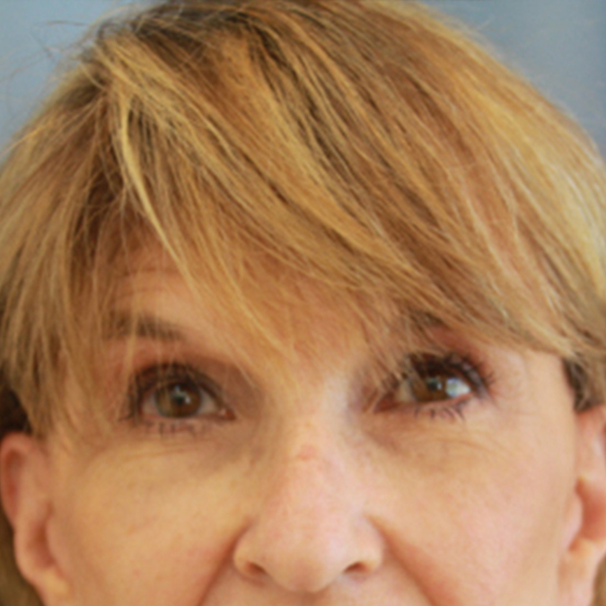 Eyelid-Surgery-Case--08 | After Eyelid Surgery