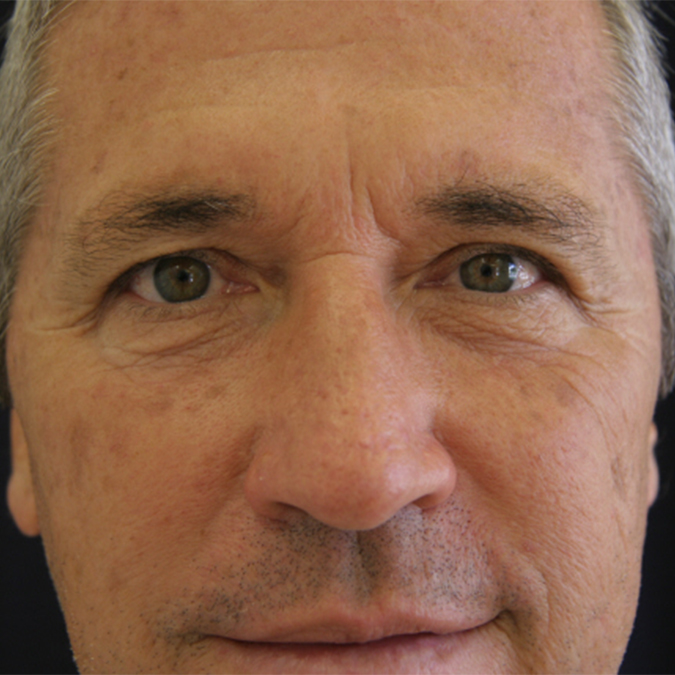 Eyelid-Surgery-Case--10 | Before Eyelid Surgery