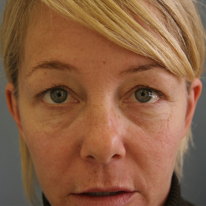 Eyelid-Surgery-Case--13 | Before Eyelid Surgery