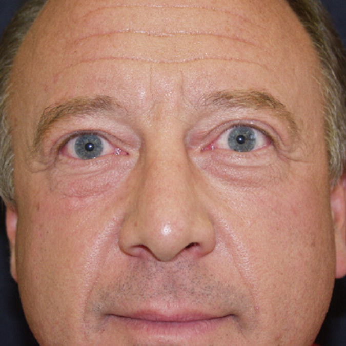 Eyelid-Surgery-Case--14 | Before Eyelid Surgery