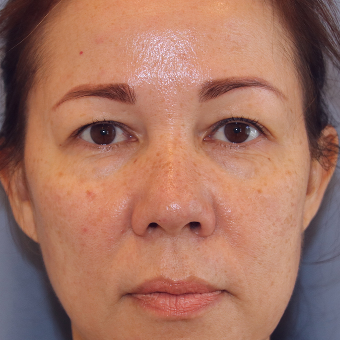 Eyelid-Surgery-Case--16 | Before Eyelid Surgery