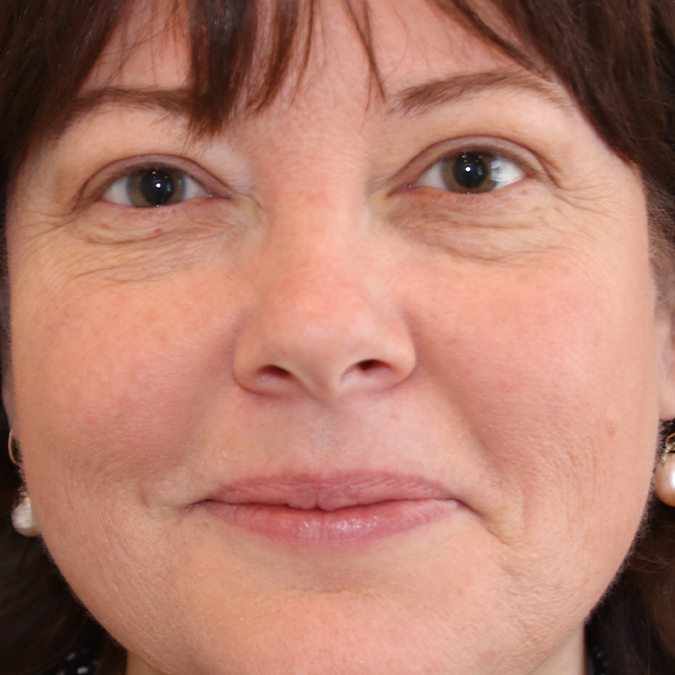 Eyelid-Surgery-Case--17 | Before Eyelid Surgery