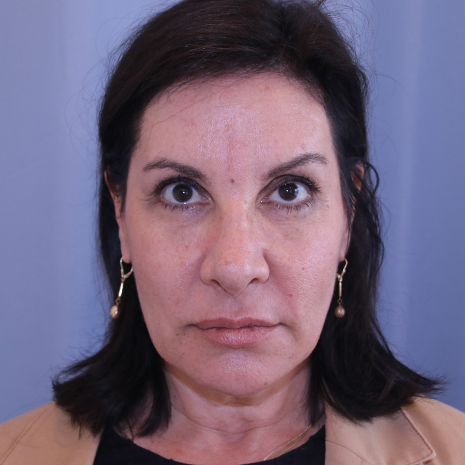 Facelift-Case--01 | Before Facelift