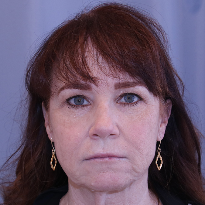 Facelift-Case--02 | Before Facelift