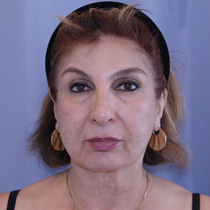 Facelift-Case--03 | Before Facelift