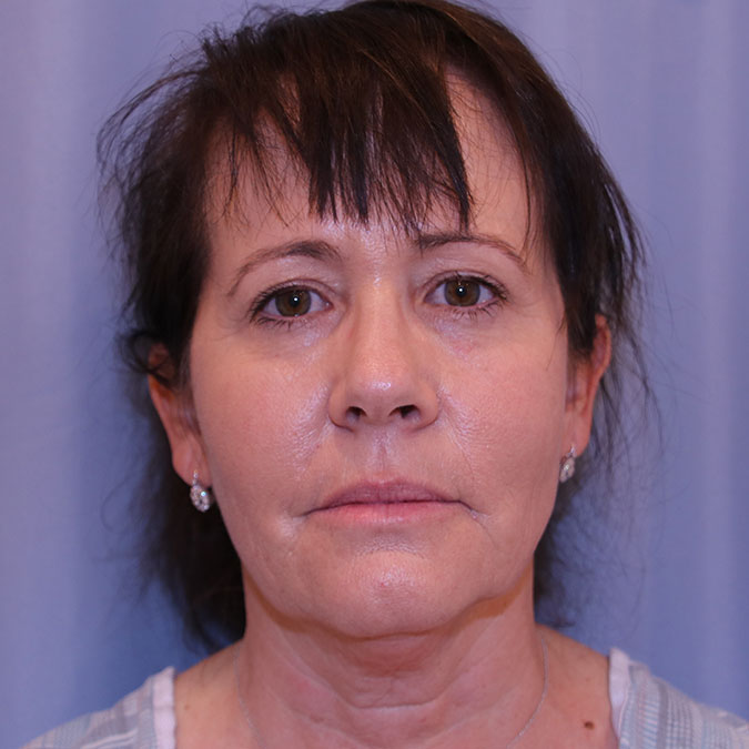 Facelift-Case--05 | Before Facelift