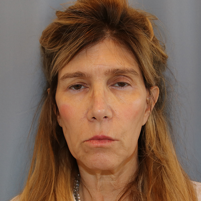 Facelift-Case--11 | Before Facelift