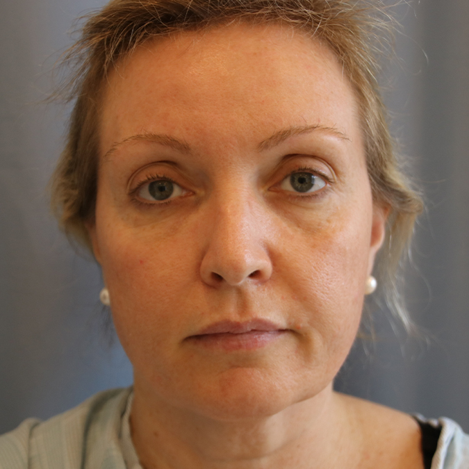 Facelift-Case--13 | Before Facelift