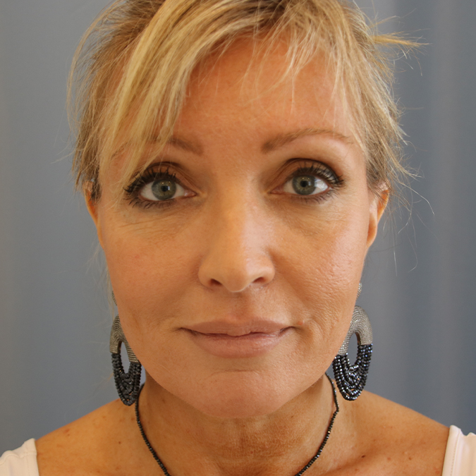 Facelift-Case--13 | After Facelift