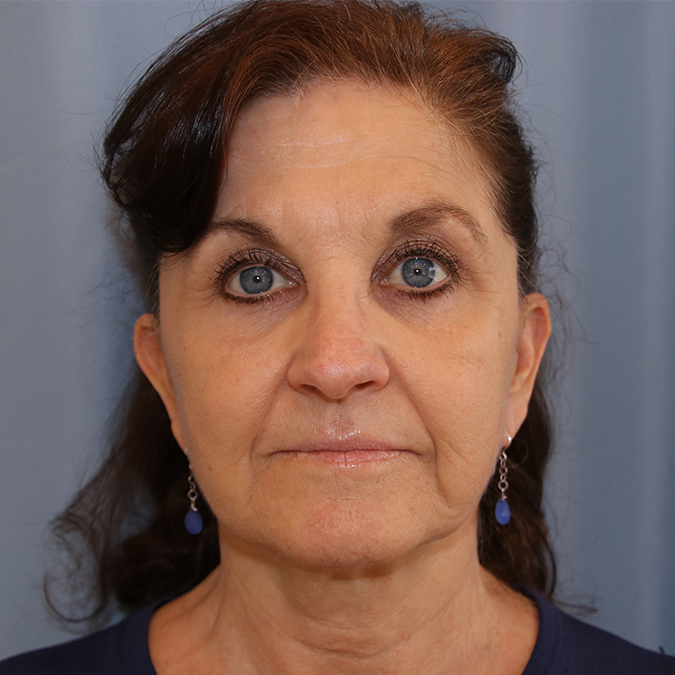 Facelift-Case--15 | Before Facelift