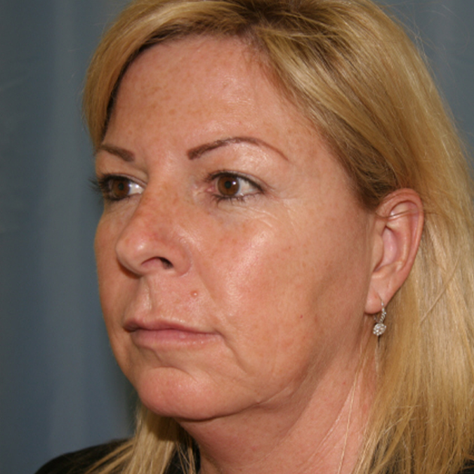 Facelift-Case--19 | Before Facelift