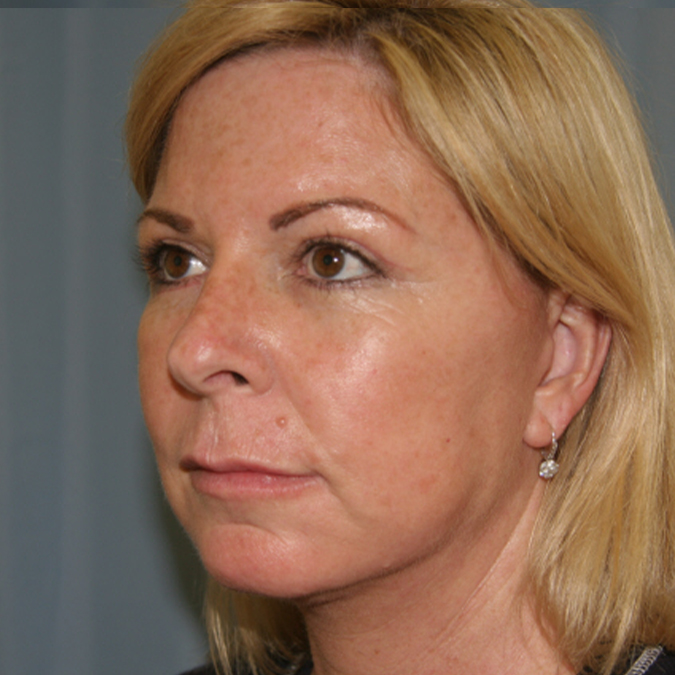 Facelift-Case--19 | After Facelift