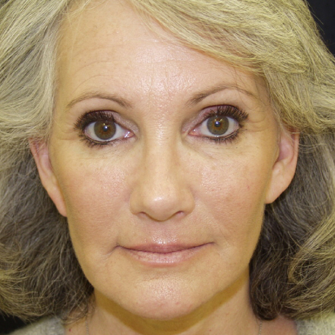 Facelift-Case--21 | After Facelift