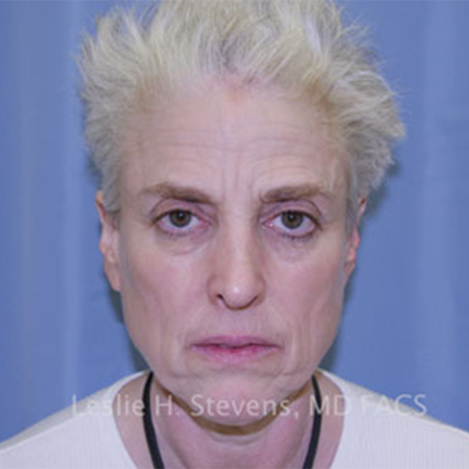Facelift-Case--25 | Before Facelift
