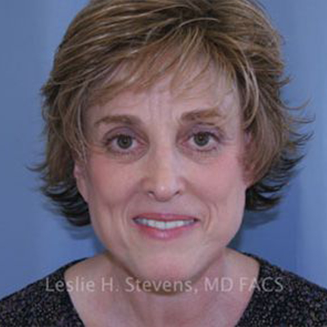 Facelift-Case--25 | After Facelift