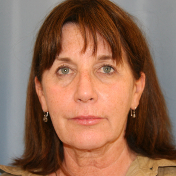 Facelift-Case--28 | Before Facelift