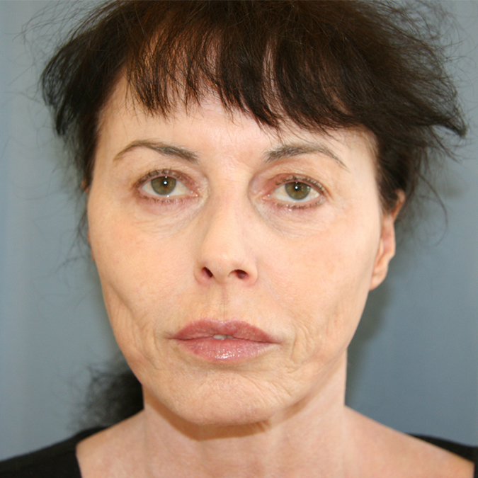 Facelift-Case--29 | Before Facelift